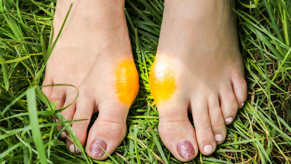 Vbočený palec lze řešit